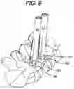 Fig. 12 - Methods and devices for minimally invasive spinal fixation element placement