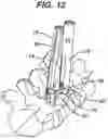 Fig. 15 - Methods and devices for minimally invasive spinal fixation element placement