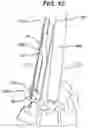 Fig. 16 - Methods and devices for minimally invasive spinal fixation element placement
