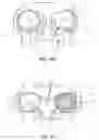 Fig. 29 - Anterior cervical plate assembly