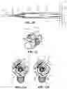 Fig. 16 - BONE FIXATION SCREW WITH DEPLOYABLE ANCHORS