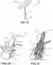 Fig. 17 - BONE FIXATION SCREW WITH DEPLOYABLE ANCHORS