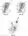 Fig. 19 - BONE FIXATION SCREW WITH DEPLOYABLE ANCHORS