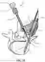 Fig. 20 - BONE FIXATION SCREW WITH DEPLOYABLE ANCHORS