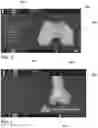 Fig. 04 - METHOD AND SYSTEM FOR NAVIGATING A BONE MODEL IN COMPUTER-ASSISTED SURGERY