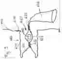Fig. 10 - Device for providing a sterile limited space for surgery
