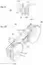 Fig. 12 - Extended buccal tube