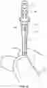 Fig. 25 - Method for forming bis-acrylic or other crown