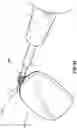 Fig. 34 - Method for forming bis-acrylic or other crown