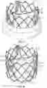 Fig. 02 - Systems and methods for sizing and implanting prosthetic heart valves