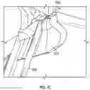 Fig. 03 - Systems and methods for sizing and implanting prosthetic heart valves