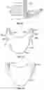 Fig. 18 - Systems and methods for sizing and implanting prosthetic heart valves