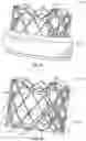 Fig. 40 - Systems and methods for sizing and implanting prosthetic heart valves