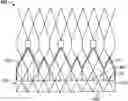 Fig. 01 - Prosthetic heart valve with paravalvular leak mitigation features