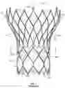 Fig. 02 - Prosthetic heart valve with paravalvular leak mitigation features