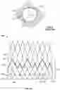 Fig. 03 - Prosthetic heart valve with paravalvular leak mitigation features