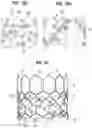 Fig. 07 - Prosthetic heart valve