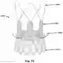 Fig. 17 - SYSTEMS, METHODS AND DEVICES FOR RETROGRADE PERICARDIAL RELEASE OF A PROSTHETIC HEART VALVE