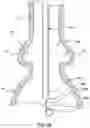 Fig. 10 - Delivery system having retractable wires as a coupling mechanism and a deployment mechanism for a self-expanding prosthesis