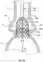 Fig. 11 - Delivery system having retractable wires as a coupling mechanism and a deployment mechanism for a self-expanding prosthesis