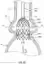 Fig. 13 - Delivery system having retractable wires as a coupling mechanism and a deployment mechanism for a self-expanding prosthesis