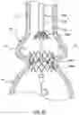 Fig. 14 - Delivery system having retractable wires as a coupling mechanism and a deployment mechanism for a self-expanding prosthesis