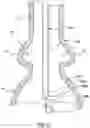 Fig. 18 - Delivery system having retractable wires as a coupling mechanism and a deployment mechanism for a self-expanding prosthesis