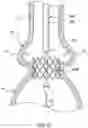 Fig. 22 - Delivery system having retractable wires as a coupling mechanism and a deployment mechanism for a self-expanding prosthesis