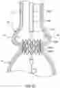 Fig. 24 - Delivery system having retractable wires as a coupling mechanism and a deployment mechanism for a self-expanding prosthesis