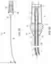 Fig. 11 - METHODS AND DEVICES FOR VENTRICULAR RESHAPING AND HEART VALVE RESHAPING