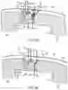 Fig. 17 - METHODS AND DEVICES FOR VENTRICULAR RESHAPING AND HEART VALVE RESHAPING