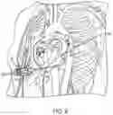 Fig. 19 - METHODS AND DEVICES FOR VENTRICULAR RESHAPING AND HEART VALVE RESHAPING