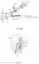 Fig. 20 - METHODS AND DEVICES FOR VENTRICULAR RESHAPING AND HEART VALVE RESHAPING