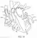 Fig. 23 - METHODS AND DEVICES FOR VENTRICULAR RESHAPING AND HEART VALVE RESHAPING