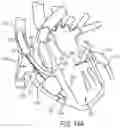 Fig. 24 - METHODS AND DEVICES FOR VENTRICULAR RESHAPING AND HEART VALVE RESHAPING