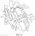 Fig. 25 - METHODS AND DEVICES FOR VENTRICULAR RESHAPING AND HEART VALVE RESHAPING