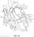 Fig. 26 - METHODS AND DEVICES FOR VENTRICULAR RESHAPING AND HEART VALVE RESHAPING