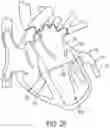 Fig. 32 - METHODS AND DEVICES FOR VENTRICULAR RESHAPING AND HEART VALVE RESHAPING