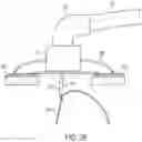 Fig. 33 - METHODS AND DEVICES FOR VENTRICULAR RESHAPING AND HEART VALVE RESHAPING