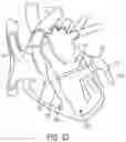 Fig. 37 - METHODS AND DEVICES FOR VENTRICULAR RESHAPING AND HEART VALVE RESHAPING