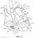 Fig. 41 - METHODS AND DEVICES FOR VENTRICULAR RESHAPING AND HEART VALVE RESHAPING