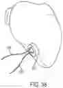 Fig. 42 - METHODS AND DEVICES FOR VENTRICULAR RESHAPING AND HEART VALVE RESHAPING