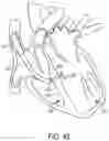 Fig. 44 - METHODS AND DEVICES FOR VENTRICULAR RESHAPING AND HEART VALVE RESHAPING