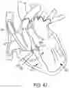 Fig. 45 - METHODS AND DEVICES FOR VENTRICULAR RESHAPING AND HEART VALVE RESHAPING