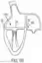 Fig. 59 - METHODS AND DEVICES FOR VENTRICULAR RESHAPING AND HEART VALVE RESHAPING