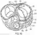 Fig. 70 - METHODS AND DEVICES FOR VENTRICULAR RESHAPING AND HEART VALVE RESHAPING