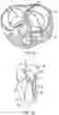 Fig. 71 - METHODS AND DEVICES FOR VENTRICULAR RESHAPING AND HEART VALVE RESHAPING