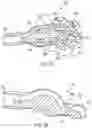 Fig. 74 - METHODS AND DEVICES FOR VENTRICULAR RESHAPING AND HEART VALVE RESHAPING