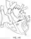 Fig. 86 - METHODS AND DEVICES FOR VENTRICULAR RESHAPING AND HEART VALVE RESHAPING
