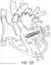 Fig. 87 - METHODS AND DEVICES FOR VENTRICULAR RESHAPING AND HEART VALVE RESHAPING